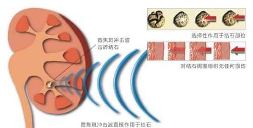 震破碎是什么检查（什么是震波碎石）