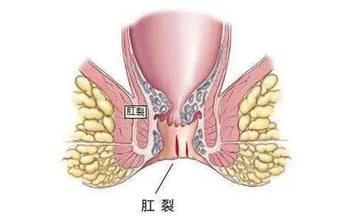 缸裂是什么原因造成的（缸裂能自愈吗）