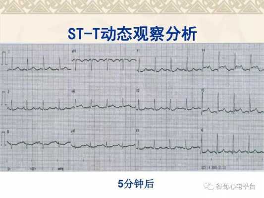 st5515什么意思（stt5556）