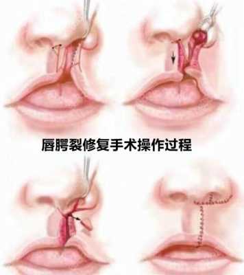 鄂裂缝补手术什么（鄂裂缝补影响说话吗）