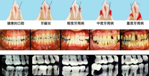 破齿难什么原因（破牙是什么意思）